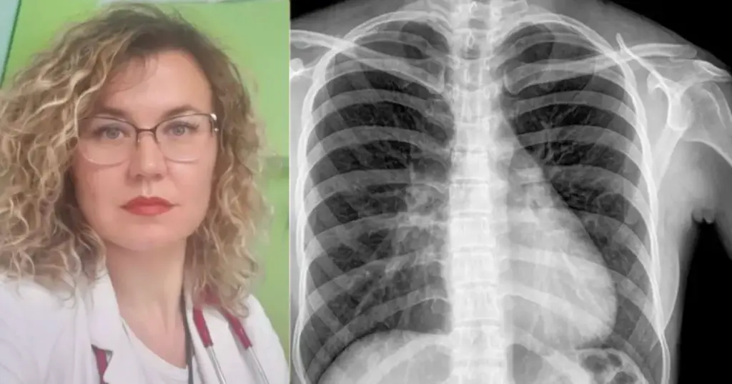 Dohranović-Tafro: Zaraza bakterijom Mycobacterium tuberculosis ne znači i bolest